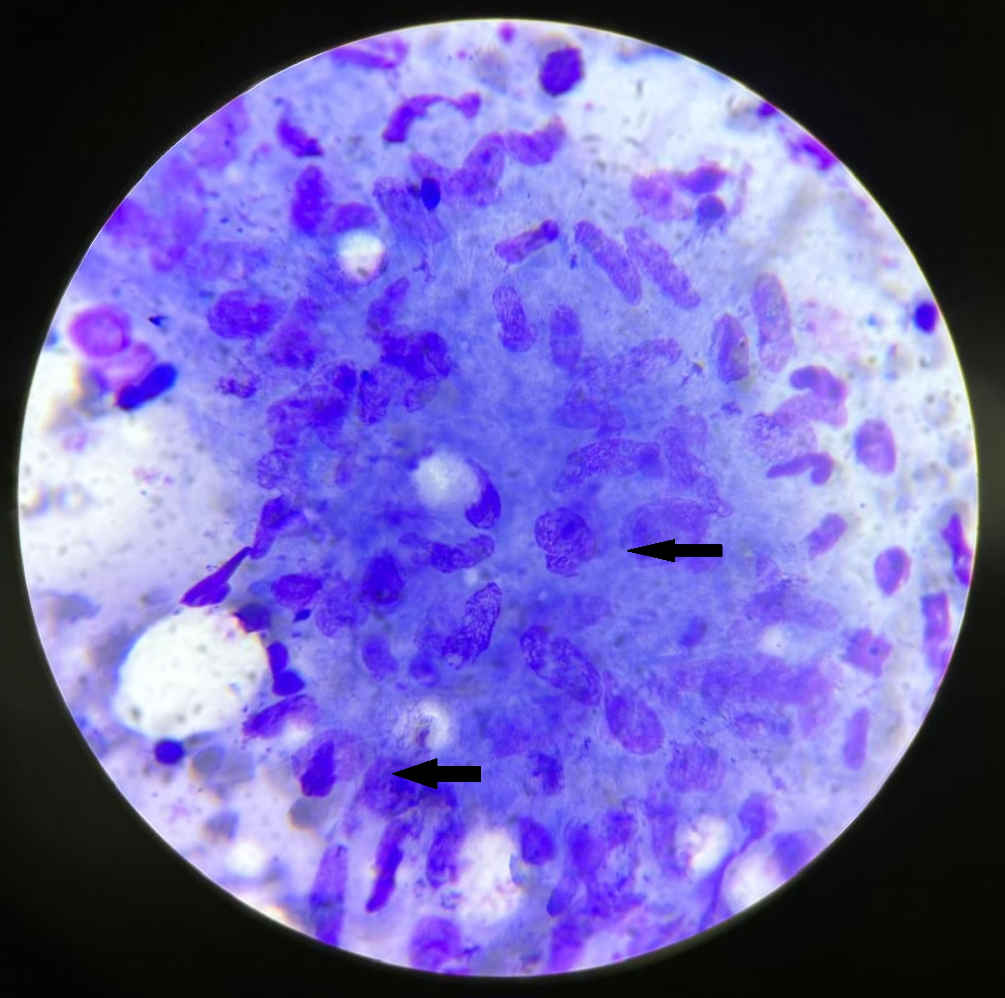 FNAC Smear showing epitheloid giant cells